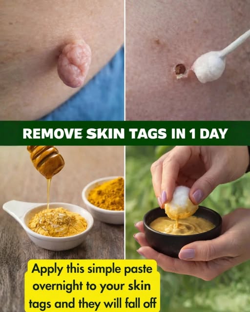 Natural Skin Tag Solutions — Benefits, Risks, and When to See a Doctor