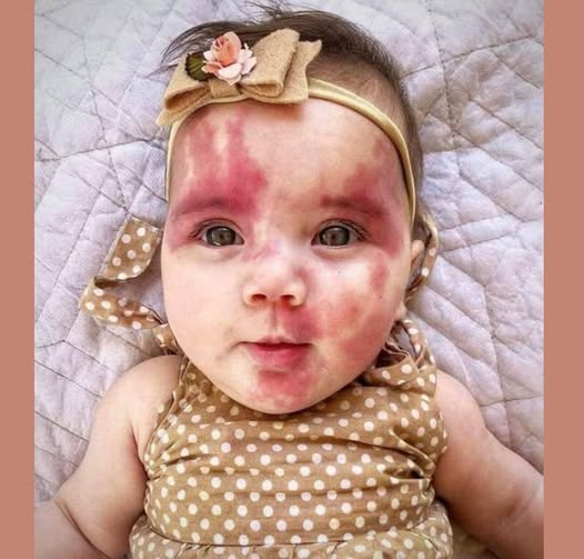 A baby with a red birthmark is described as “hideous” and “defective,” but wait until you see this gorgeous child!