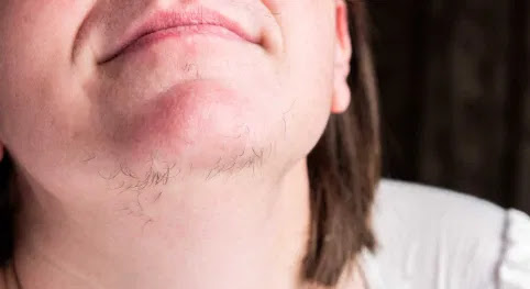 Chin Whiskers in Women — What’s Normal, What’s Not, and How to Navigate It Without Shame