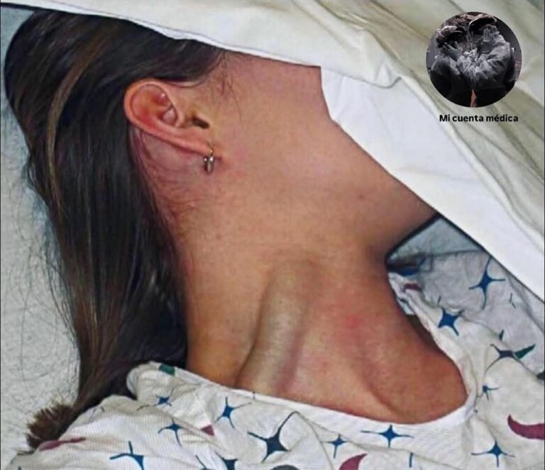 Massive Jugular Vein Distension (JVD): A Serious Warning Sign You Shouldn’t Ignore
