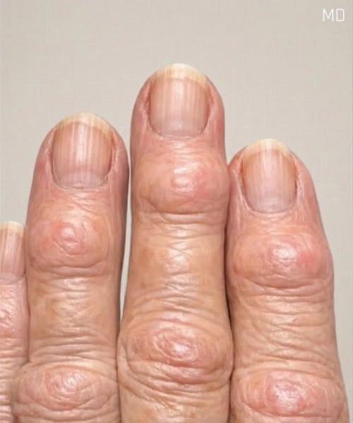 On the joints of her fingers, close to the nails, my grandmother is developing these hard lumps. What’s causing this to spread?