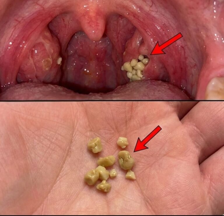 What Tonsil Stones Are, How to Safely Remove Them, and Why Relief Is More Realistic Than “Forever”