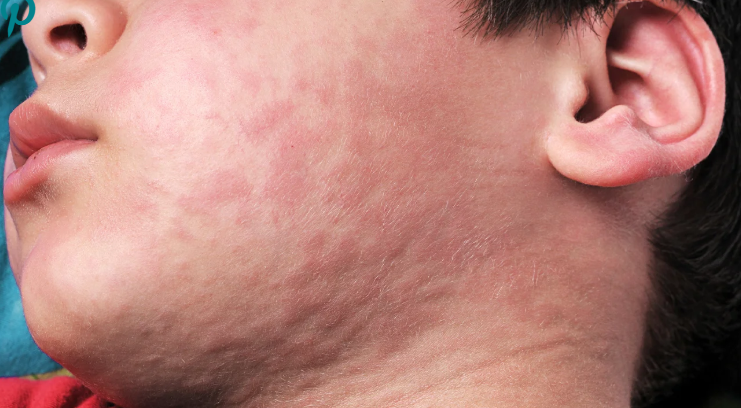 He was diagnosed with an allergy after his entire body began to itch.
