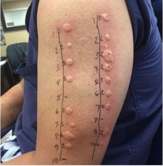 When an Itch Isn’t Just an Itch: James’s Story and the Silent Warning Signs of Skin Conditions